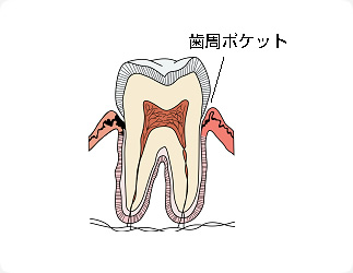 口臭の原因になります