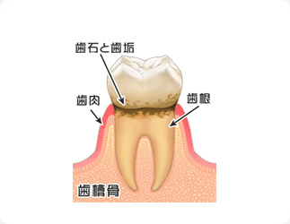 ＜歯肉炎＞