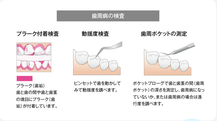 歯周病の検査