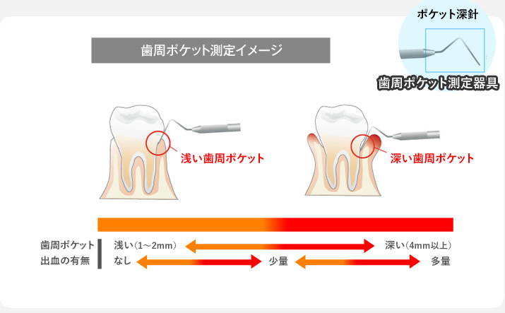 歯周ポケット測定イメージ