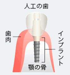 インプラントとはどのように治療するの？