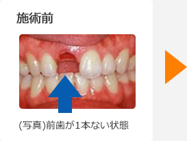 (写真)前歯が1本ない状態