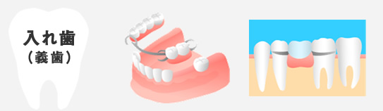 入れ歯（義歯）