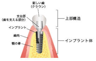 インプラント金額