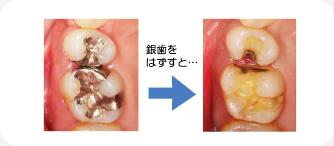 年に一回の虫歯のレントゲン検査