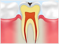 C1 エナメル質の虫歯