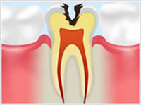 C2 象牙質の虫歯
