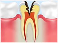C3　象牙質の虫歯