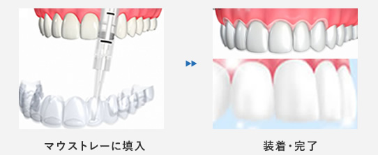 マウストレーに填入/装着・完了