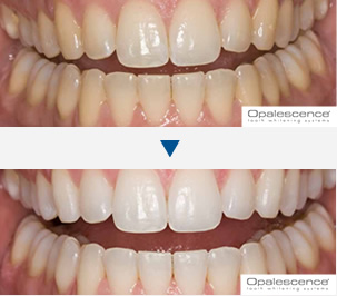 ホワイトニング治療例1