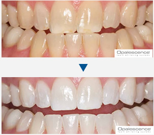 ホワイトニング治療例2