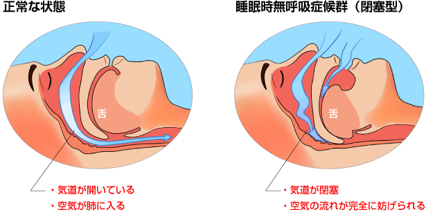 いびき