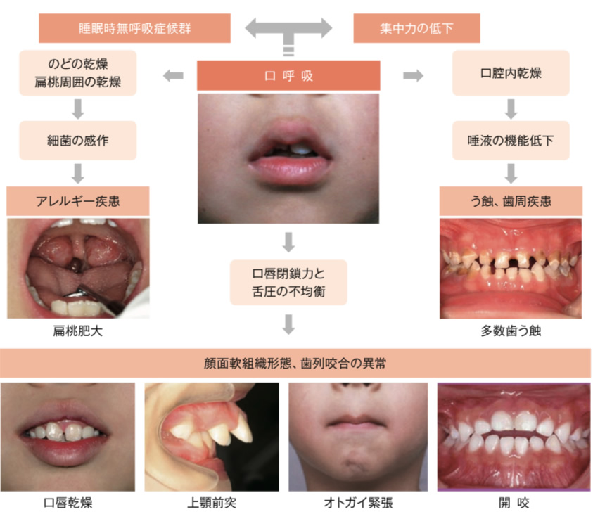 口呼吸について