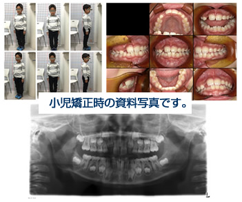 小児矯正時の資料写真です。